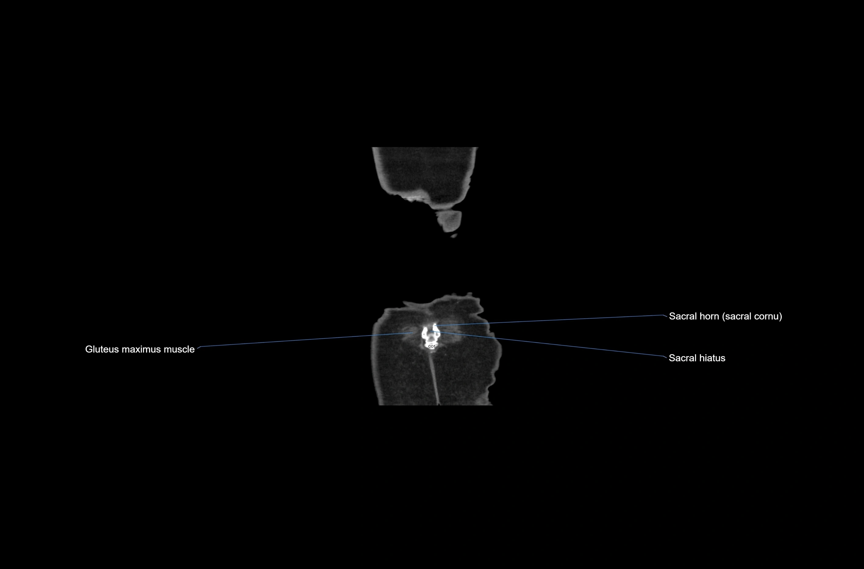 CT abdomen coronal cross sectional anatomy labelled radiology image-00085.webp